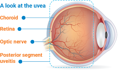 symptoms of uveitis present in the eye
